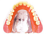 Co-Cr（コバルト-クロム）床入れ歯